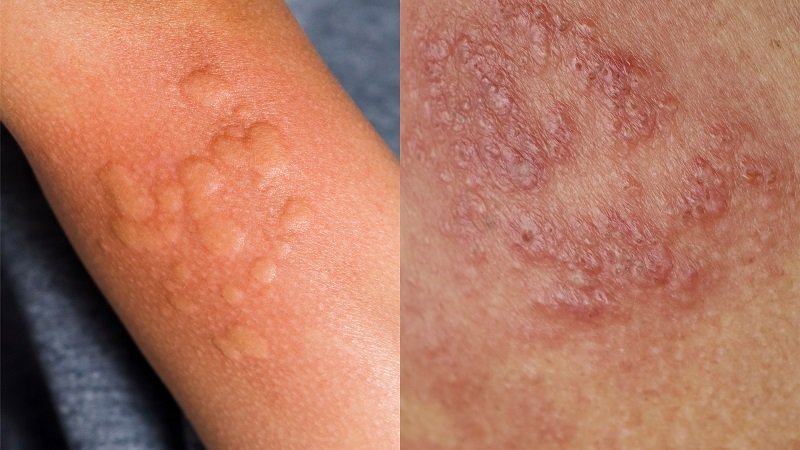 Eczema (Itching)